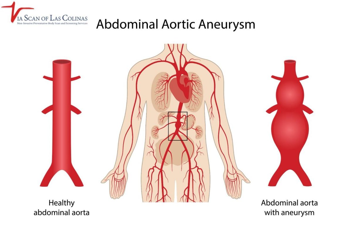 Abdominal-Aortic-Aneurysm-Symptoms-1200x792.jpg